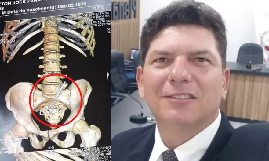 Médicos esquecem tesoura dentro de estômago de vereador que fazia cirurgia de emergência