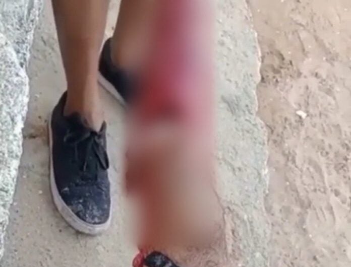 Surfista de 32 anos é atacado por tubarão em praia de Olinda