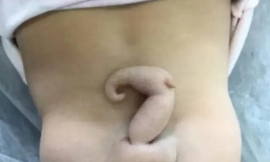 Bebê brasileira nasce com ‘cauda’ de 6 cm