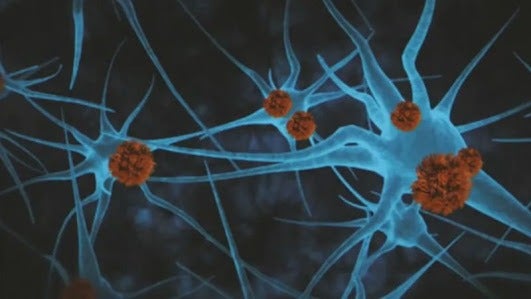 Estudo aponta que droga retarda progressão do Alzheimer em 60% para pacientes em estágios iniciais