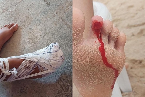 Adolescente e Jovem São Atacadas por Piranhas na Prainha de Petrolândia-PE