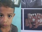 Menino de 6 anos de Cabrobó precisa de R$ 13,5 mil para cirurgia de retirada de lesão óssea na maxila
