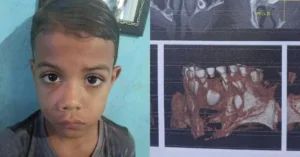 Menino de 6 anos de Cabrobó precisa de R$ 13,5 mil para cirurgia de retirada de lesão óssea na maxila