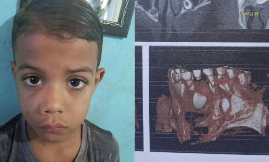 Menino de 6 anos de Cabrobó precisa de R$ 13,5 mil para cirurgia de retirada de lesão óssea na maxila